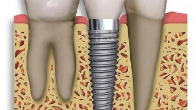Implantes: una solución que hay que cuidar como los dientes.