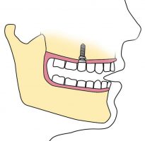 Implantología, prótesis dental y cirugía oral